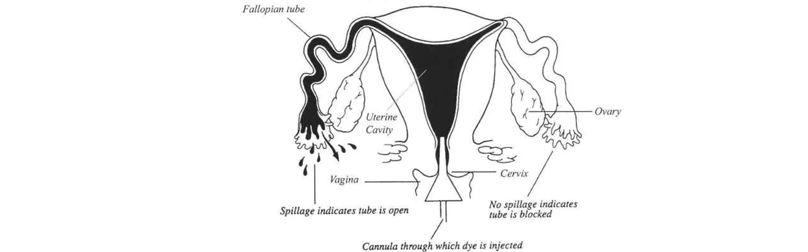 Why is the HSG test Done?